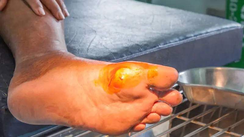 Ugonjwa wa kisukari, Visababishi, Dalili za Kisukari Mwilini, Madhara na Matibabu.